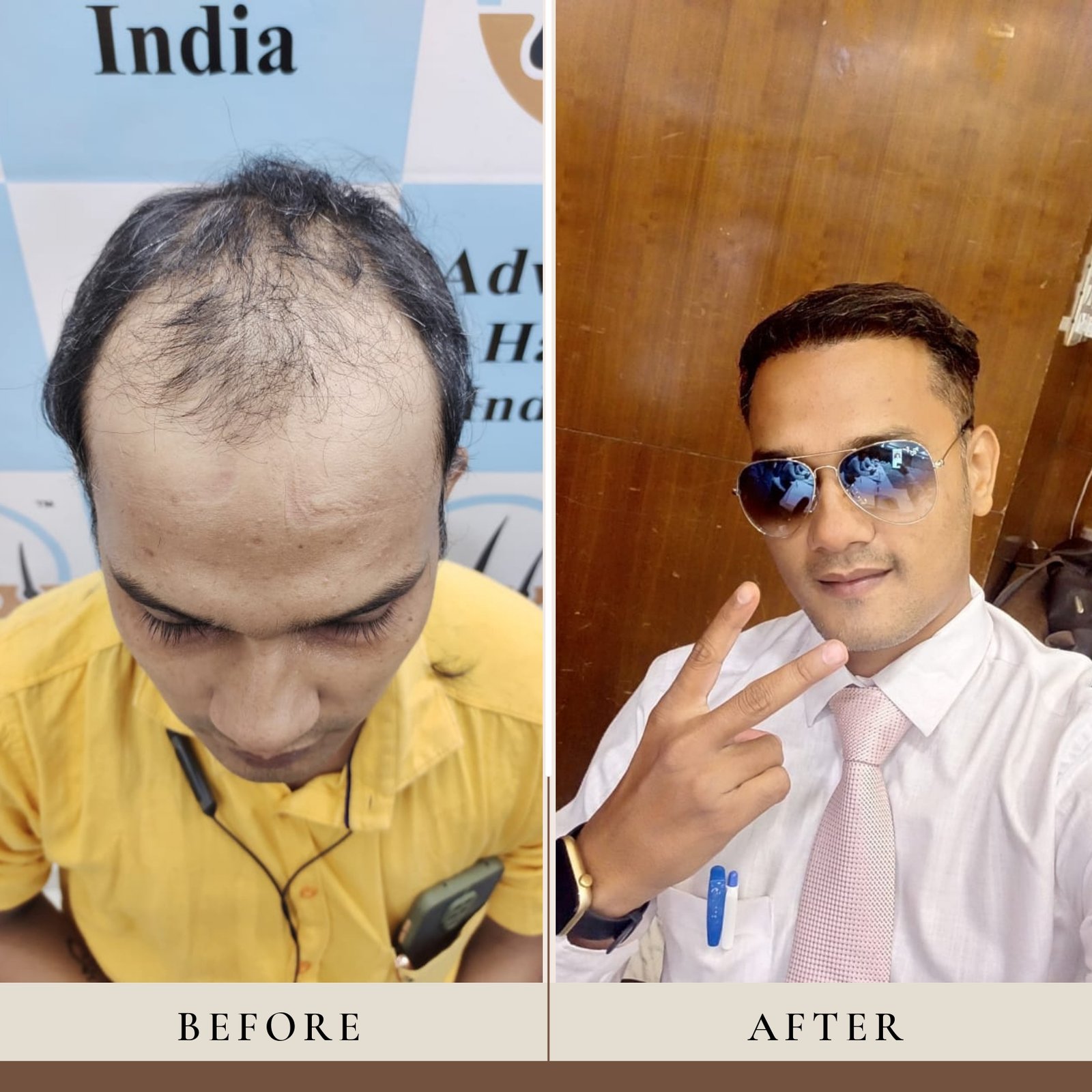 Hair Transplant Result
