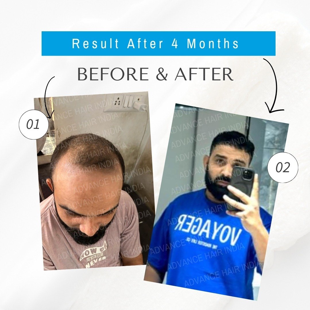 Hair Transplant Result