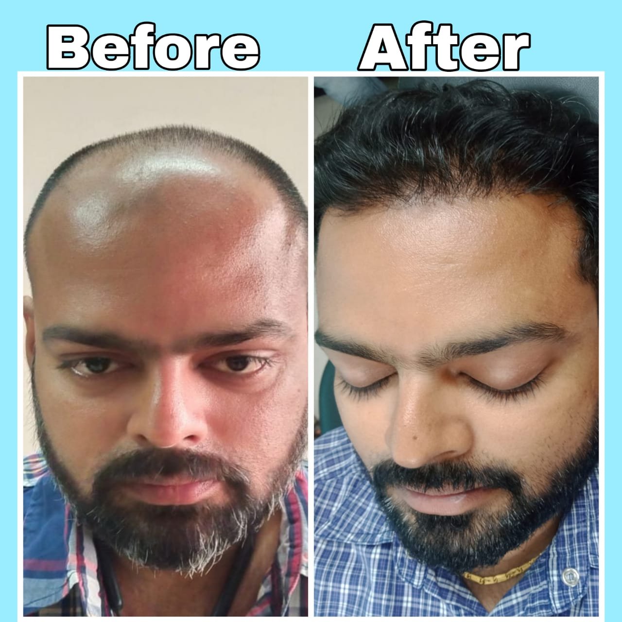 Hair Transplant Result